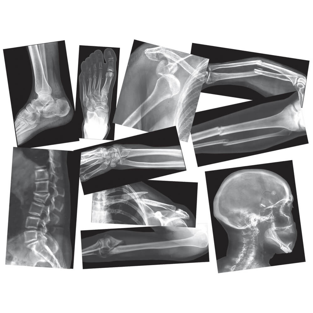 Røntgenbilleder af knoglebrud fra Roylco