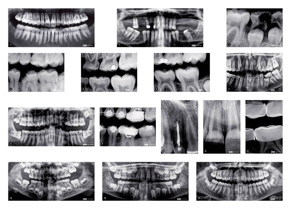 Røntgenbilleder af tænder fra Roylco 