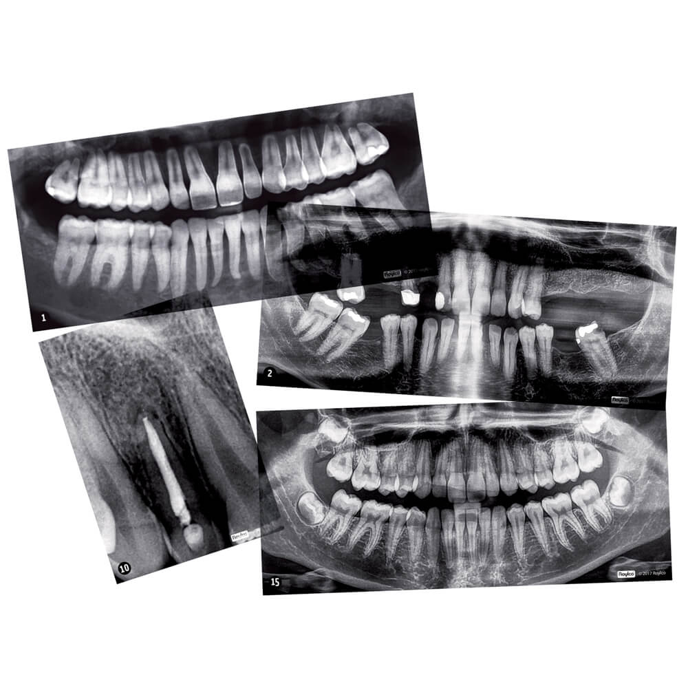 Røntgenbilleder af tænder fra Roylco 
