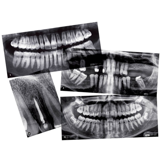 Røntgenbilleder af tænder fra Roylco 